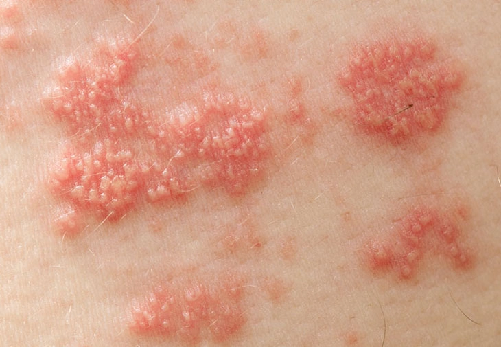 Zona Thần Kinh và Khả Năng Lây Nhiễm: Phương Pháp Lây Truyền Phổ Biến 1 zona than kinh